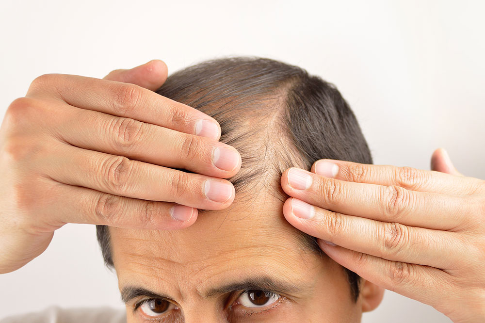 Easy Hair Loss Prevention Tips for Men and Women