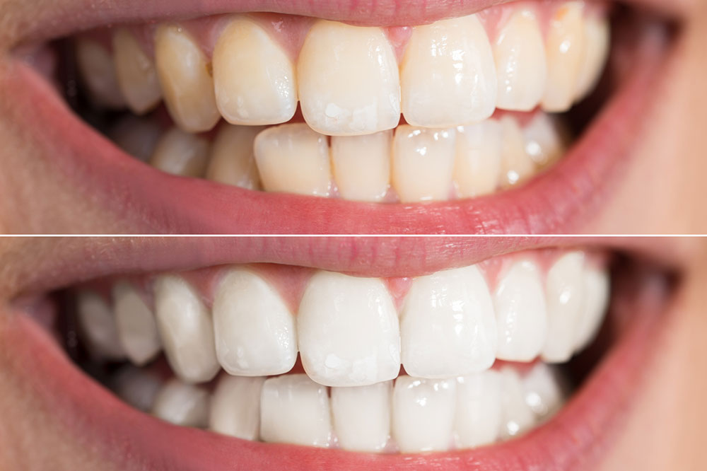 Top 3 Teeth Whitening Products to Try at Home