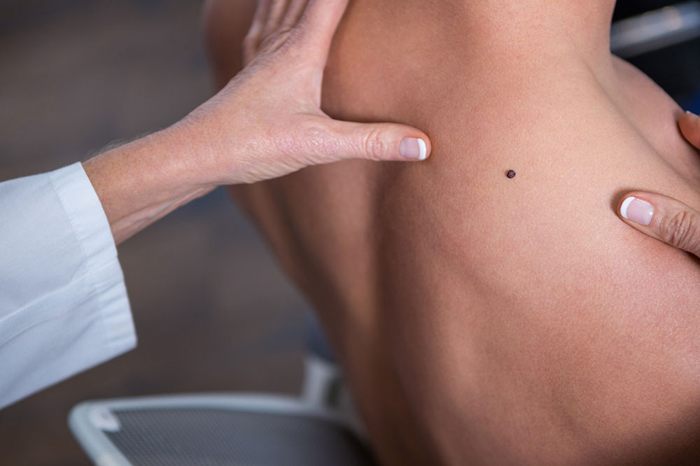 7 Prevalent Risk Factors of Melanoma